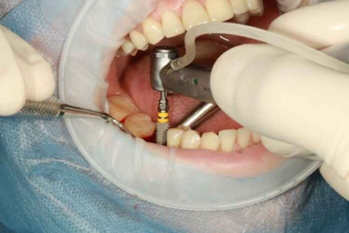 How to Choose Dentists for Implants